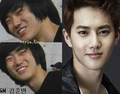 exo整容前后照片,蜕变之路，颜值巅峰